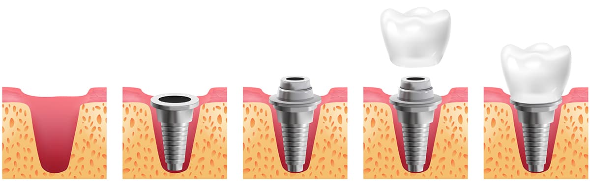 Основные этапы имплантации зубов