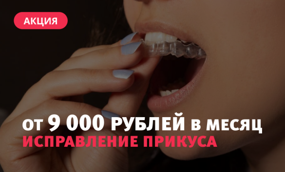  Выравнивание зубов без брекетов