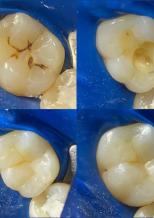 Реставрация зуба по поводу кариеса  фотокомпозитом